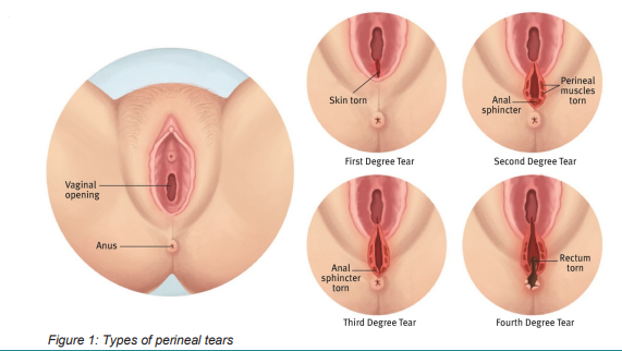 Perineal Tearing During Childbirth: Causes, Severity, and